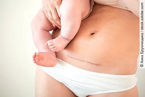 Mom's abdomen after cesarean section. Scar seam. A young mother holds the baby in her arms. Real motherhood. Lifestyle