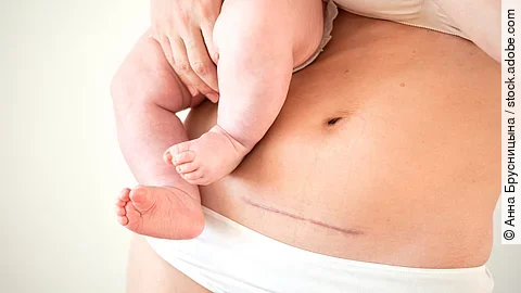 Mom's abdomen after cesarean section. Scar seam. A young mother holds the baby in her arms. Real motherhood. Lifestyle