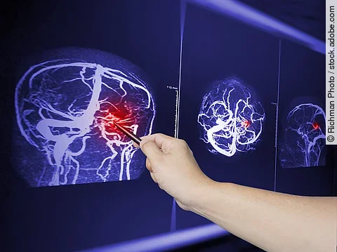 Close up Hand doctor point MRA brian scan image of a recent trau