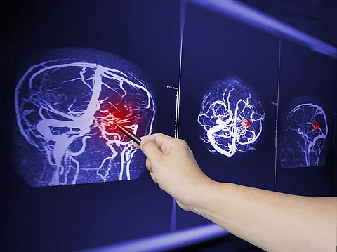 Close up Hand doctor point MRA brian scan image of a recent trau