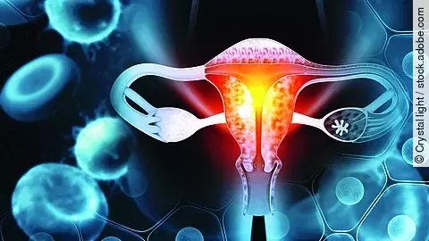 Illustration der weiblichen inneren Geschlechtsorgane mit hervorgehobenem Uterus und Eierstöcken; umgeben von stark vergrößerten Zellen und molekularen Strukturen, die eine Mikroumgebung im Bauchraum darstellen.