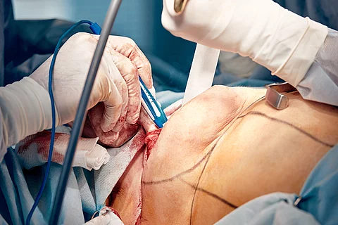 Mamoplasty, breast reconstruction, the surgeon's hands place an 