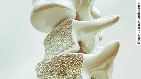 Osteoporosis on the spine - 3d rendering
