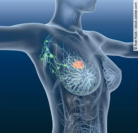 Breast cancer, lymphatics, mastocarcinoma