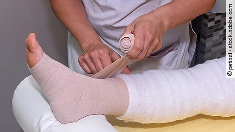 Lymphedema management: Wrapping leg using multilayer bandages to control Lymphedema. Part of complete decongestive therapy (cdt) and manual lymphatic drainage (MLD)