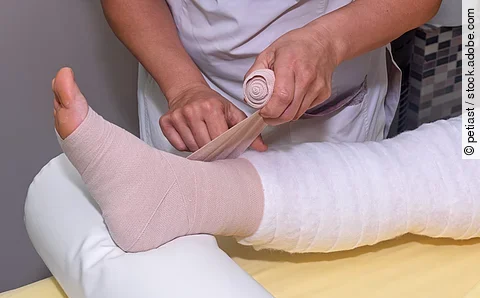 Lymphedema management: Wrapping leg using multilayer bandages to control Lymphedema. Part of complete decongestive therapy (cdt) and manual lymphatic drainage (MLD)