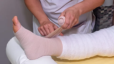 Lymphedema management: Wrapping leg using multilayer bandages to control Lymphedema. Part of complete decongestive therapy (cdt) and manual lymphatic drainage (MLD)