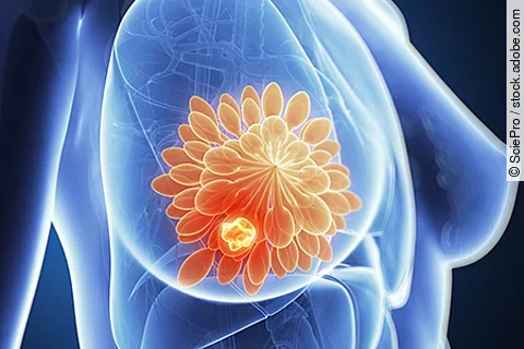 Modellarische Darstellung von Brustkrebs