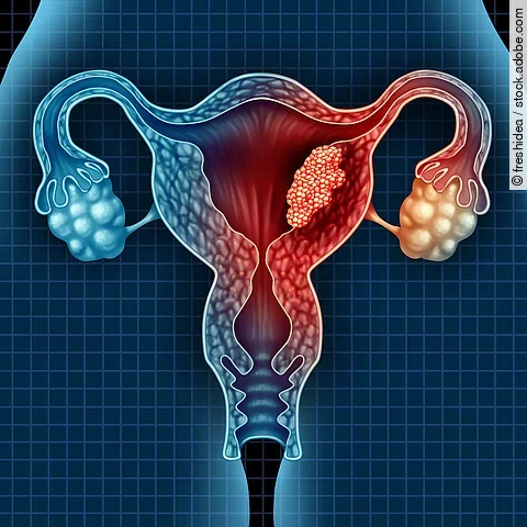 Zervixkarzinom: leicht verständliche Infos