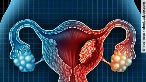 Zervixkarzinom: leicht verständliche Infos