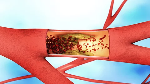 Ablagerung und Verengung einer Aterie - Arteriosklerose Ablagerung und Verengung einer Aterie - Arteriosklerose